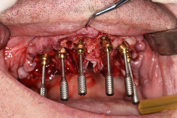 Montarea bonturilor multi-unit pe implanturile din maxilar