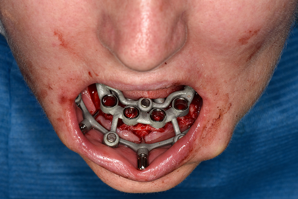 Ghid chirurgical stackable fixat pe mandibulă