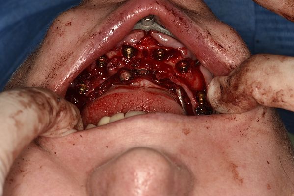 Ghid chirurgical pe maxilar cu bonturile multi-unit montate